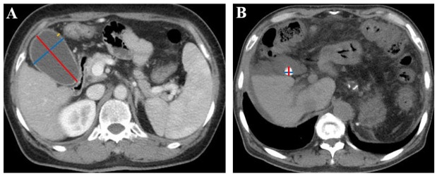 Associations of gallbladder and gallstone parameters with clinical outcomes in patients with cirrhosis.