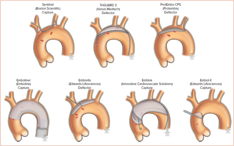 Cerebral Embolic Protection Devices: Current State of the Art.