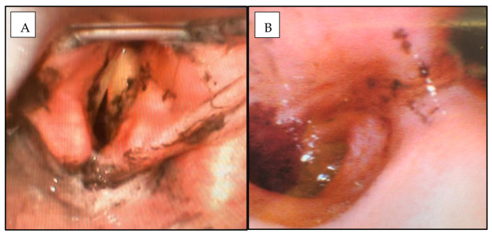 Review of Indications for Endotracheal Intubation in Burn Patients with Suspected Inhalational Injury.