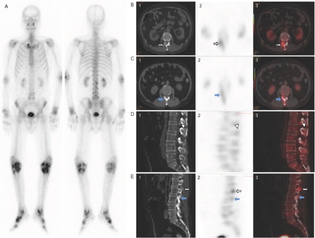 Single photon emission computed tomography/computed tomography imaging of gouty arthritis: A new voice.