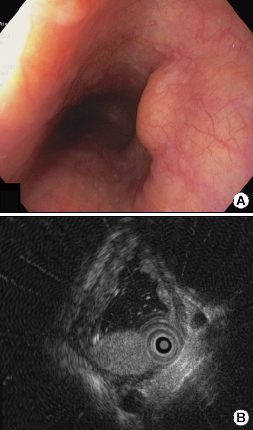 Homogenous Subepithelial Esophageal Lesion.