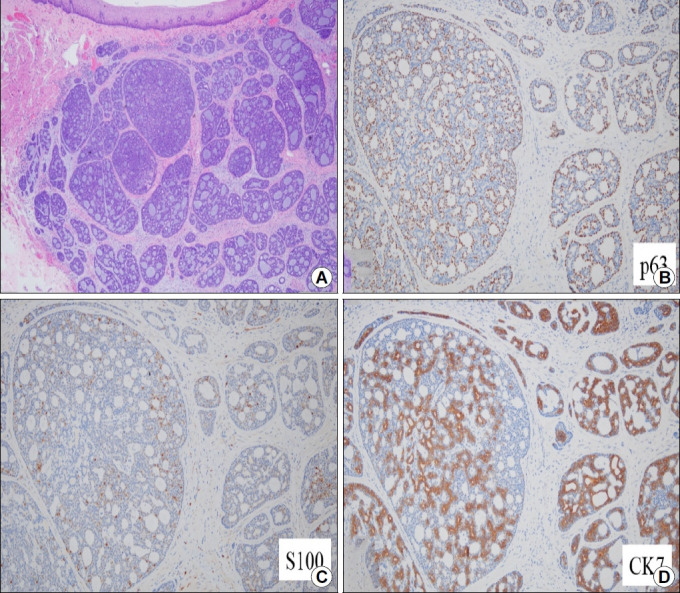 Homogenous Subepithelial Esophageal Lesion.