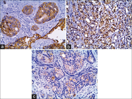 Alpha Thalassemia/Intellectual Disability Syndrome X-Linked Expression Varies Significantly between Androgen Receptor-Positive and Androgen Receptor-Negative Prostatic Adenocarcinoma: Relation to Epidermal Growth Factor Receptor Expression and Clinicopathological Factors.