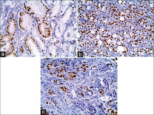 Alpha Thalassemia/Intellectual Disability Syndrome X-Linked Expression Varies Significantly between Androgen Receptor-Positive and Androgen Receptor-Negative Prostatic Adenocarcinoma: Relation to Epidermal Growth Factor Receptor Expression and Clinicopathological Factors.