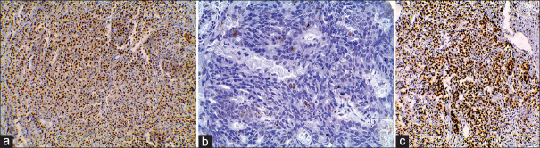 Alpha Thalassemia/Intellectual Disability Syndrome X-Linked Expression Varies Significantly between Androgen Receptor-Positive and Androgen Receptor-Negative Prostatic Adenocarcinoma: Relation to Epidermal Growth Factor Receptor Expression and Clinicopathological Factors.