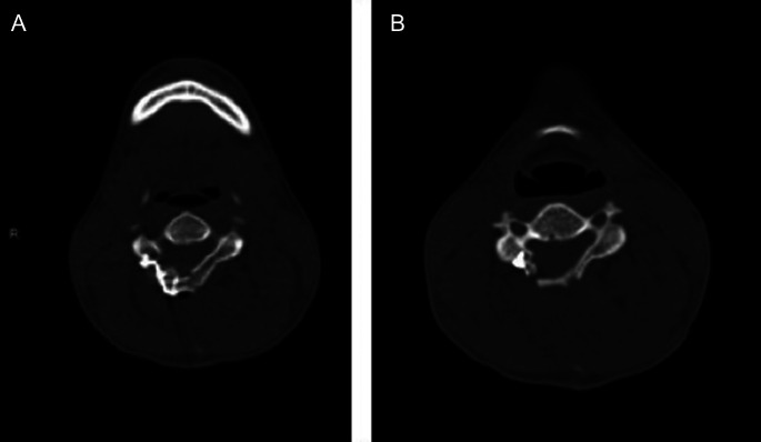 An unusual case of pediatric cervical myelopathy due to congenital spinal canal stenosis.