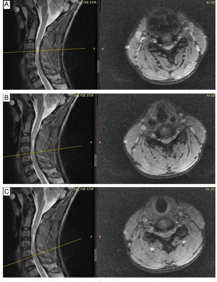 An unusual case of pediatric cervical myelopathy due to congenital spinal canal stenosis.