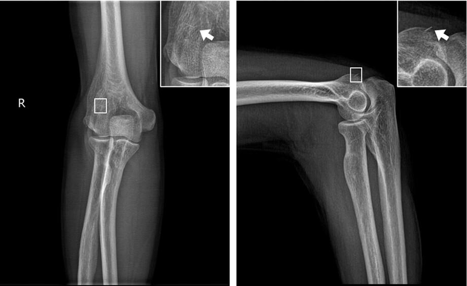 Effect of a reused insulin needle remaining in a patient's body