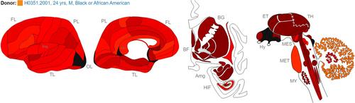 Alignment of human aquaporin 4 and ß-amyloid proteins may indicate involvement of ß-amyloid in brain water homeostasis and prevention of brain edema