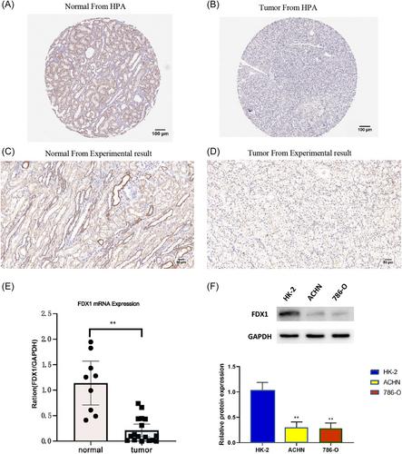 Ferredoxin 1, the key regulator of cuproptosis, was associated with prognosis and immune cell infiltration in clear cell renal cell carcinoma