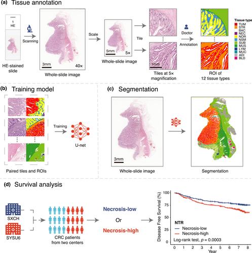 Automated assessment of necrosis tumor ratio in colorectal cancer using an artificial intelligence-based digital pathology analysis