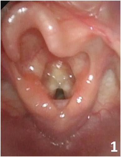 Endoscopic surgery under tubeless anesthesia and spontaneous breathing for a congenital laryngeal web in an infant: A case report