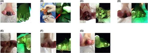 Instantly evaluating bacterial infections on skin ulcers in an Asian population using a fluorescence-emitting device