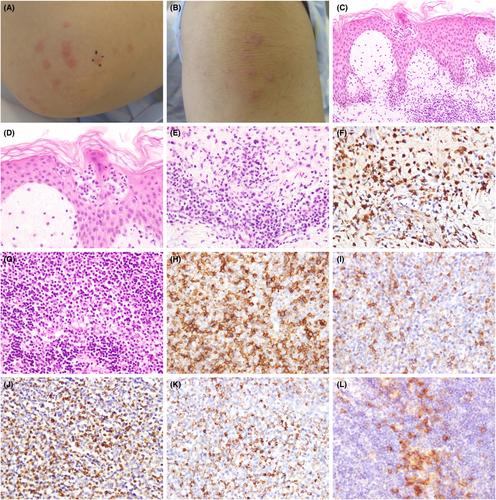 Kikuchi-Fujimoto disease presenting with papular lesions on the elbows and knees