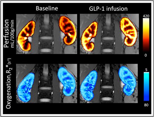 Multiparametric magnetic resonance imaging: A robust tool to test pathogenesis and pathophysiology behind nephropathy in humans