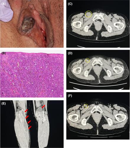 A case of ruptured Baker's cyst induced by nivolumab and ipilimumab