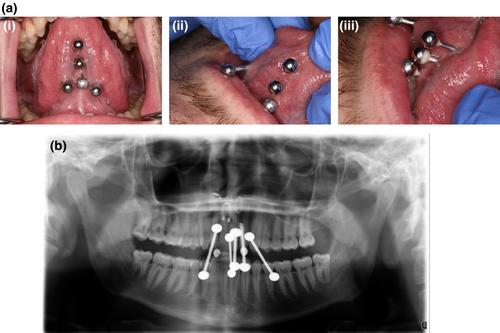 Ion release from oral piercings from in vitro acidic challenges