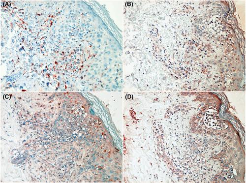 The significance of M1-polarized CD163+ macrophages in acute graft-versus-host disease (GVHD): Possible mechanisms of GVHD in the development of skin lesions