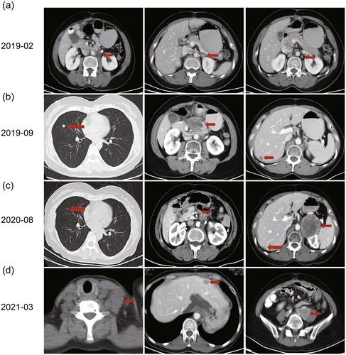 Large cell neuroendocrine carcinoma transformation: A novel acquired drug resistance mechanism in colorectal adenocarcinoma