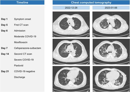 Should Paxlovid be prescribed for patients with severe COVID-19 in the late course of infection? A case report