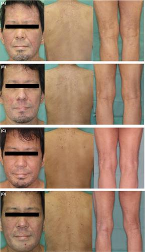 Immediate exacerbation of atopic dermatitis after switching from upadacitinib to dupilumab: A report of two cases