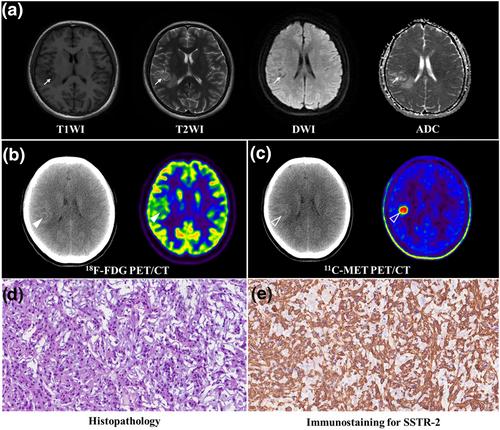 11C-MET PET and 18F-FDG PET characteristics of chordoid meningioma