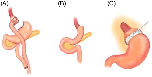 Obesity in children and adolescents: Overview of the diagnosis and management