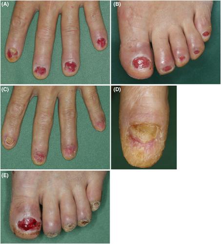 Nail toxicity with nail bed ulceration associated with pembrolizumab