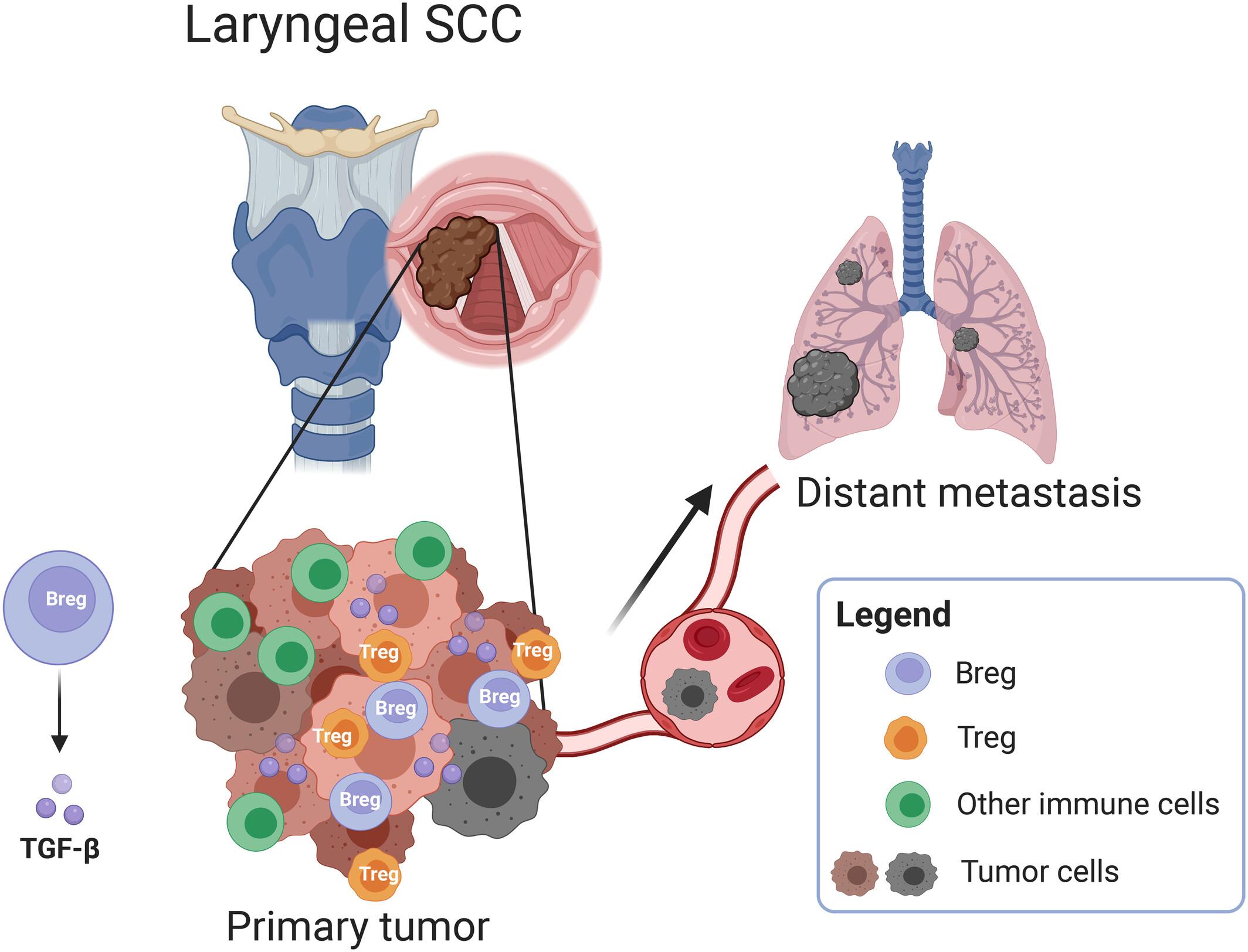 The prometastatic relevance of tumor-infiltrating B lymphocytes in laryngeal squamous cell carcinoma