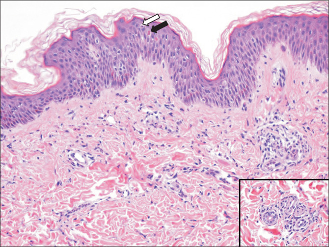 The SLC29A3 variant, neutrophilic dermatosis, and hyperferritinemia imitate systemic juvenile idiopathic arthritis in a Saudi child: a case report.