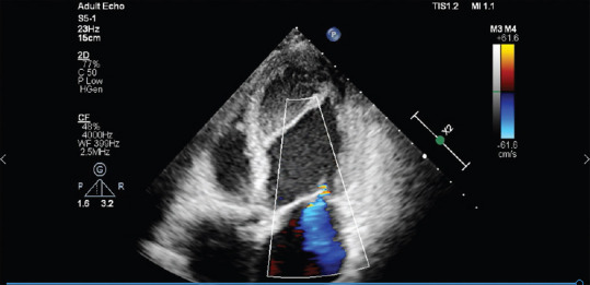 A Rare Case of Intramyocardial Dissecting Hematoma following Acute Myocardial Infarction.