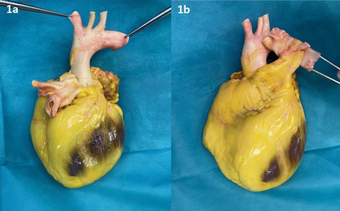 How to counteract the lack of donor tissue in cardiac surgery? Initial experiences with a newly established homograft procurement program.