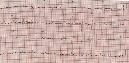 A Rare Case of Intramyocardial Dissecting Hematoma following Acute Myocardial Infarction.