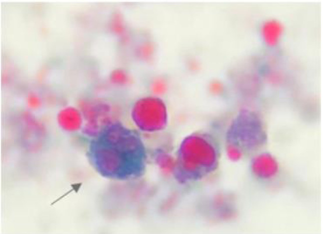 [Amoebic liver abscess in a patient from Gambia].