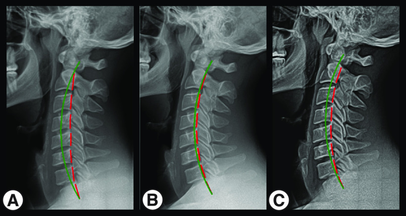 Post-concussion syndrome and concussion incidence improved in a pro rugby player following cervical spine rehab: case study and 6-year follow-up.