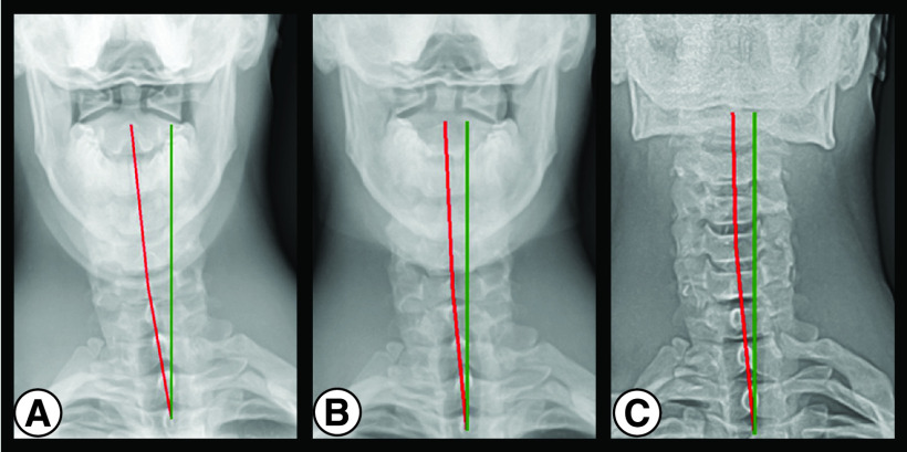 Post-concussion syndrome and concussion incidence improved in a pro rugby player following cervical spine rehab: case study and 6-year follow-up.