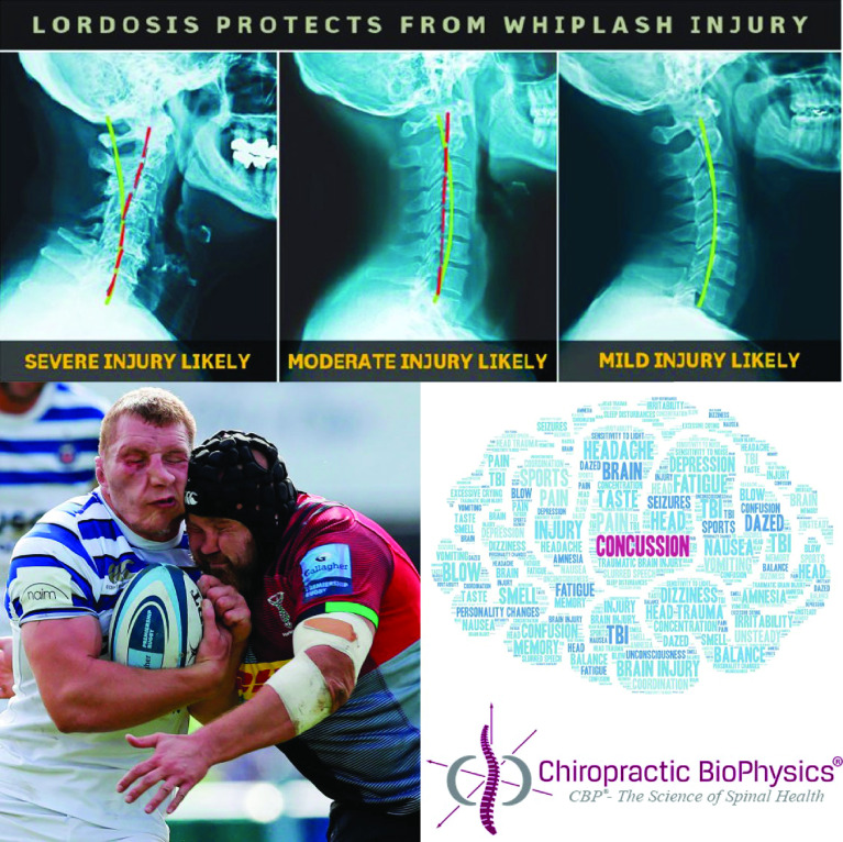 Post-concussion syndrome and concussion incidence improved in a pro rugby player following cervical spine rehab: case study and 6-year follow-up.