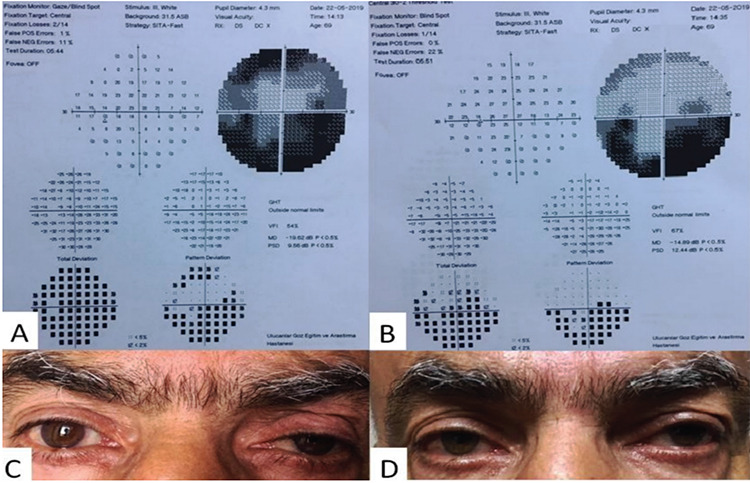 Factors Affecting the Incidence of Ptosis after Trabeculectomy.