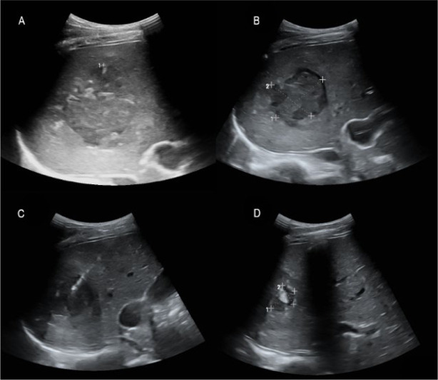 [Amoebic liver abscess in a patient from Gambia].