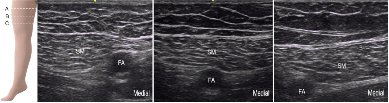 Comparison of the Effectiveness of Ultrasound-Guided Proximal, Mid, or Distal Adductor Canal Block after Knee Arthroscopy.