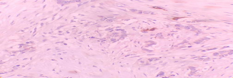 Prognostic Significance of Microvessel Density in Invasive Ductal Carcinoma of Breast.