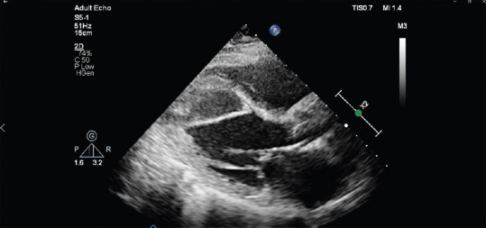 A Rare Case of Intramyocardial Dissecting Hematoma following Acute Myocardial Infarction.