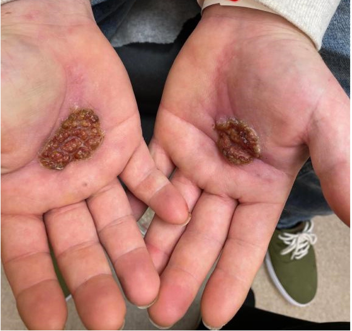 The Continued Rise of Syphilis: A Case Report to Aid in Identification of the Great Imitator.