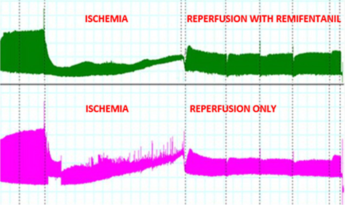 Remifentanil but not sufentanil induces cardioprotection in human ischemic heart muscle in vitro.