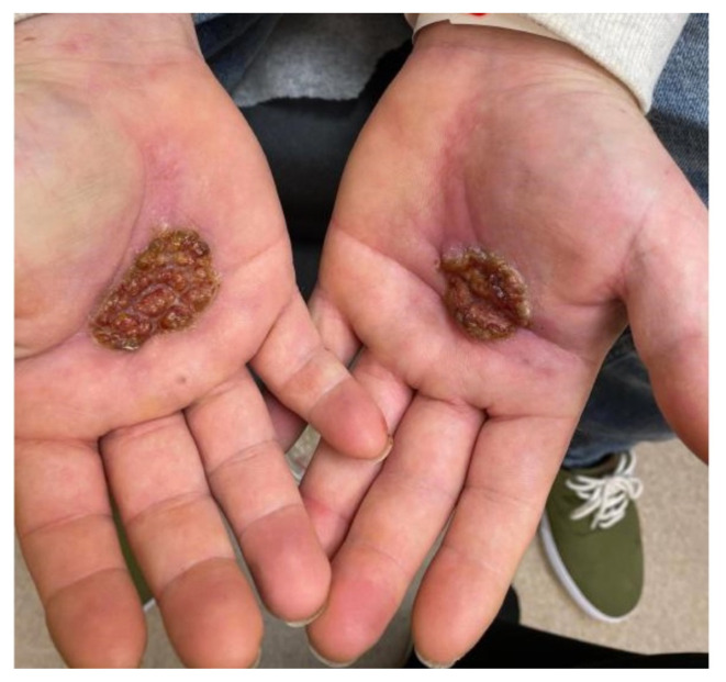 The Continued Rise of Syphilis: A Case Report to Aid in Identification of the Great Imitator.