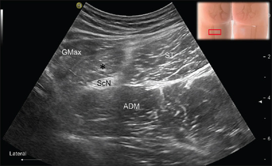 A 42-year-old Man with Posterior Thigh Pain.