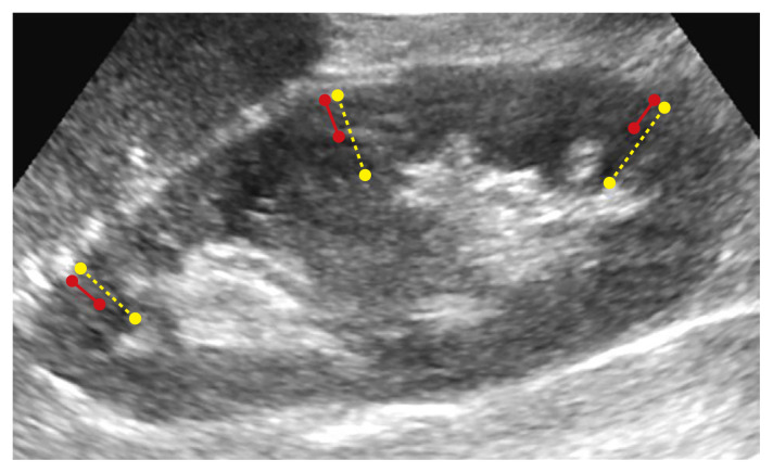 Impact of preoperative ultrasonography for predicting the prognosis of deceased donor kidney transplantation.