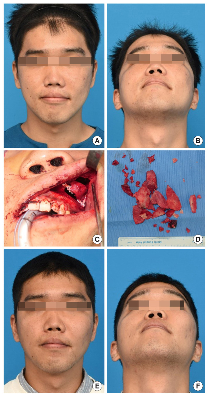 Long-term outcomes after core extirpation of fibrous dysplasia of the zygomaticomaxillary region.