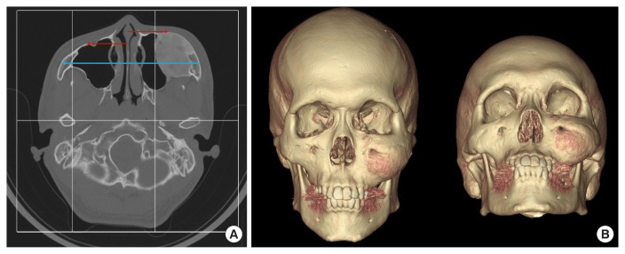 Long-term outcomes after core extirpation of fibrous dysplasia of the zygomaticomaxillary region.