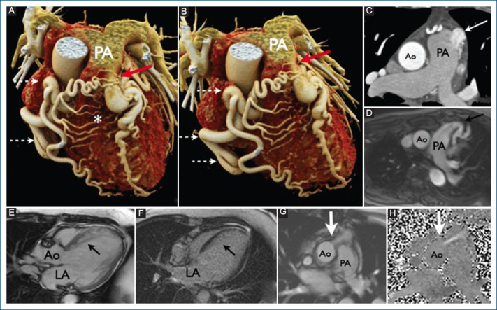 An unusual association: Chronic coronary syndrome and Bland-White-Garland syndrome.